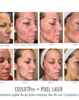 CO2Lift® Pro Carboxy Gel Treatment
