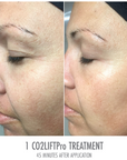 CO2Lift® Pro Carboxy Gel Treatment