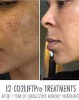 CO2Lift® Pro Carboxy Gel Treatment