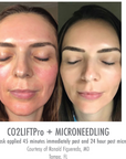 CO2Lift® Pro Carboxy Gel Treatment
