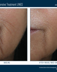 Skinbetter InterFuse Intensive Treatment LINES