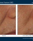 Skinbetter InterFuse Intensive Treatment LINES