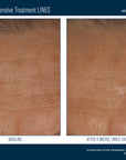 Skinbetter InterFuse Intensive Treatment LINES