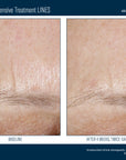 Skinbetter InterFuse Intensive Treatment LINES
