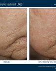 Skinbetter InterFuse Intensive Treatment LINES