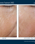 Skinbetter InterFuse Intensive Treatment LINES