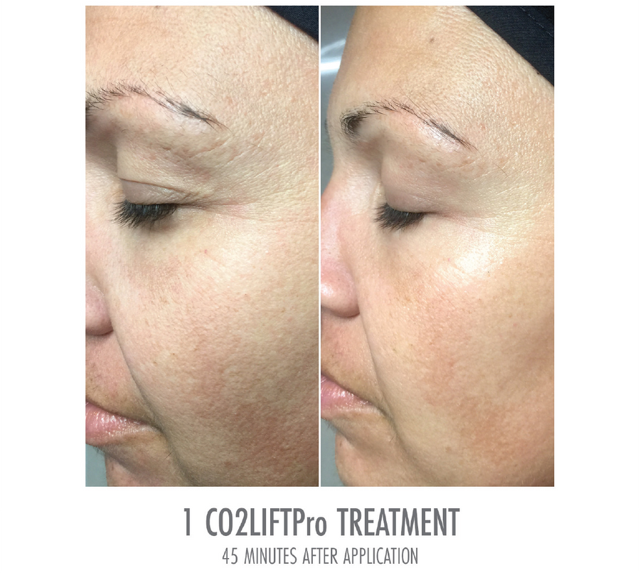 CO2Lift® Pro - Triple Pack (3 Treatments)