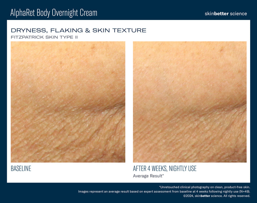 Skinbetter NEW! AlphaRet Body Overnight Cream