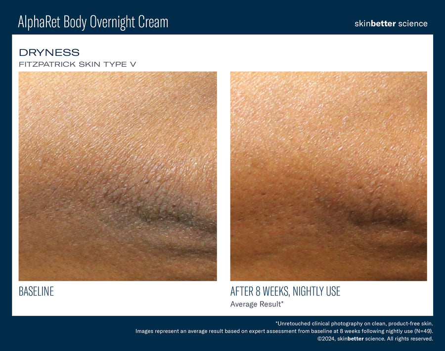 Skinbetter NEW! AlphaRet Body Overnight Cream