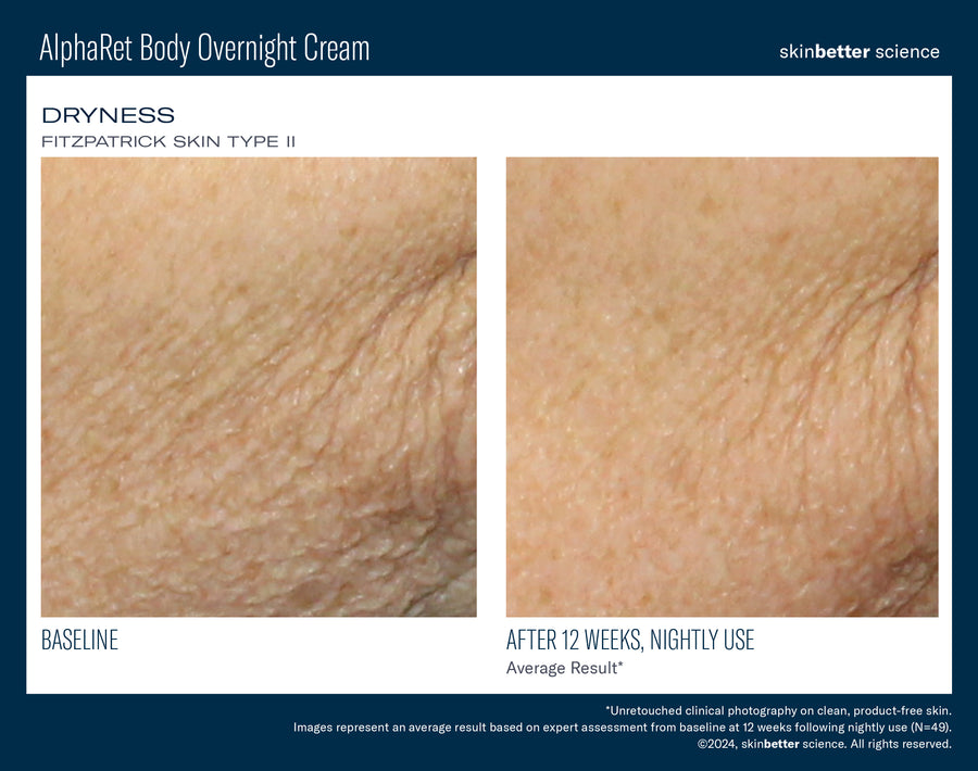 Skinbetter NEW! AlphaRet Body Overnight Cream