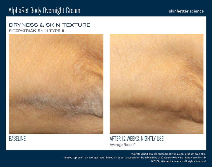 Skinbetter NEW! AlphaRet Body Overnight Cream