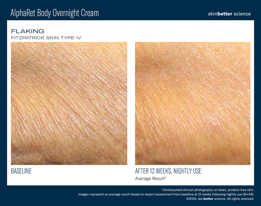 Skinbetter NEW! AlphaRet Body Overnight Cream