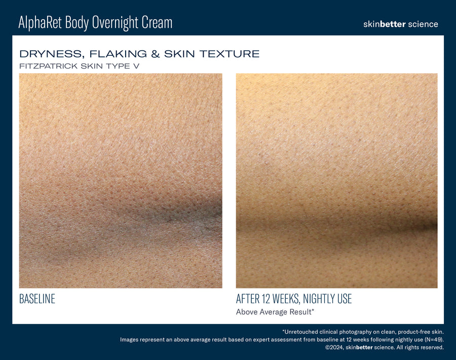 Skinbetter NEW! AlphaRet Body Overnight Cream