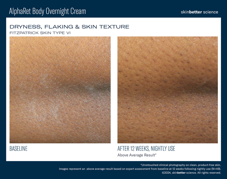 Skinbetter NEW! AlphaRet Body Overnight Cream