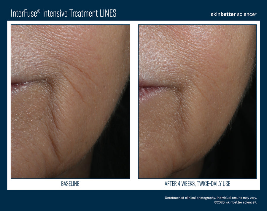 Skinbetter InterFuse Intensive Treatment LINES