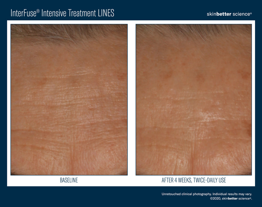 Skinbetter InterFuse Intensive Treatment LINES