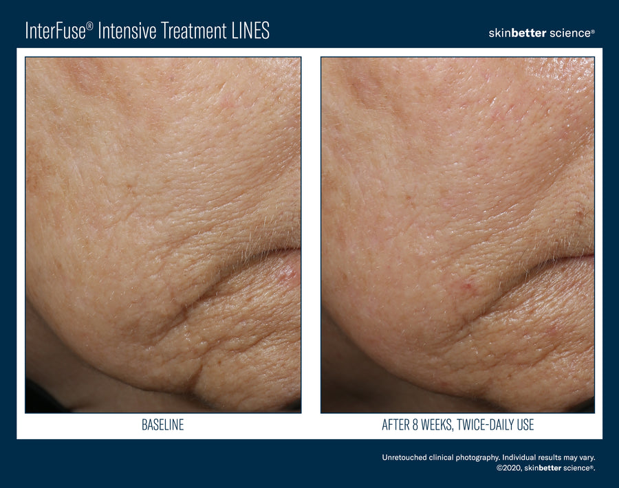 Skinbetter InterFuse Intensive Treatment LINES