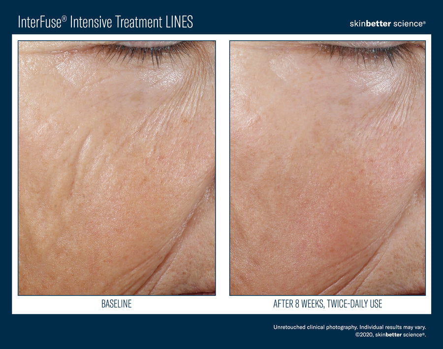 Skinbetter InterFuse Intensive Treatment LINES