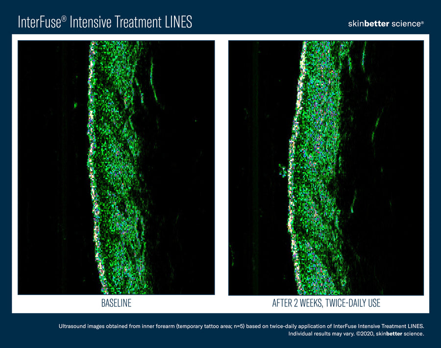 Skinbetter InterFuse Intensive Treatment LINES
